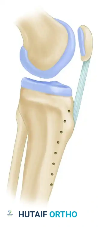 Tibial Tubercle Osteotomy