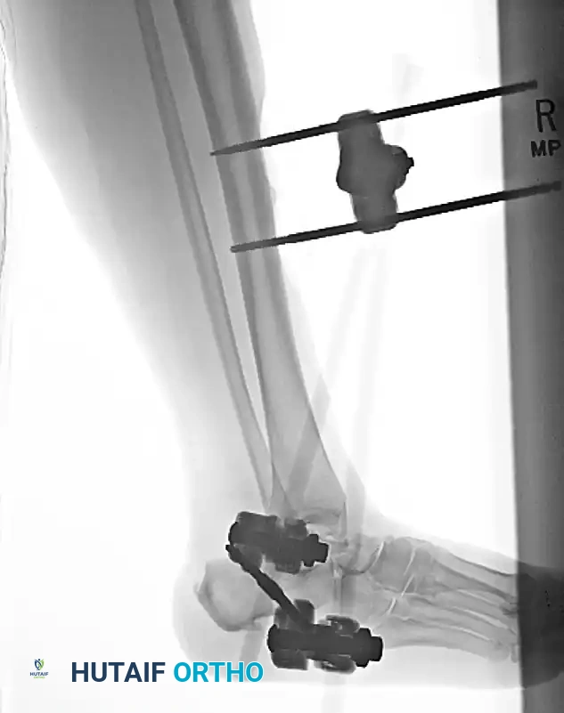 Subtalar Dislocations: Comprehensive Operative Management and Surgical Techniques