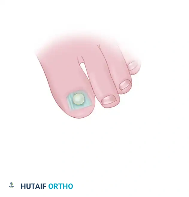 SUBUNGUAL AND PERIUNGUAL FIBROMAS Surgical Diagram