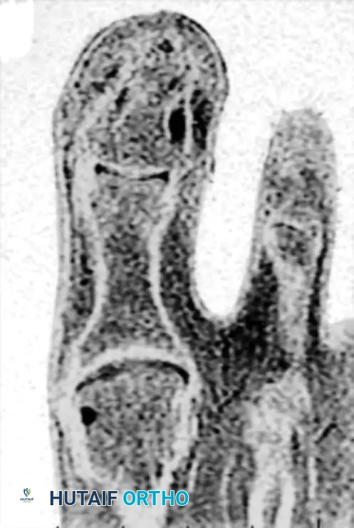SUBUNGUAL AND PERIUNGUAL FIBROMAS Surgical Diagram