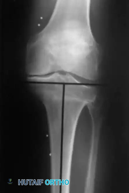 Fig. 6-53 Frequently after high tibial osteotomy, lateral tibial bone defi ciency is present because of valgus deformity of proximal tibia.