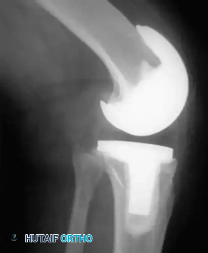 Fig. 6-54 Posterior cruciate ligament–substituting arthroplasty performed for previous patellectomy and osteoarthritis.