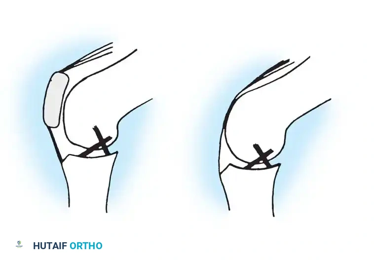 Fig. 6-55 Four-bar linkage system. Patellar tendon is roughly parallel to the posterior cruciate ligament, and quadriceps tendon is roughly parallel to anterior cruciate. Loss of patella results in considerable alteration of mechanical axis and destroys four-bar linkage between extensor mechanism and cruciates. (From Bayne O, Cameron HU: Total knee arthroplasty following patellectomy, Clin Orthop Relat Res 186:112, 1984.)