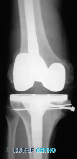Fig. 6-56 Total knee arthroplasty performed for hemophilic arthropathy with medial tibial structural autograft and PressFit stems.