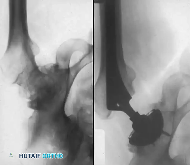 Fig. 7-73 Inadequate deepening of acetabulum. A and B, Degenerative arthritis with intraarticular osteophyte formation and lateral subluxation. Medial osteophytes were not removed, and socket remains in lateralized position. Superior coverage is provided only by large osteophyte.