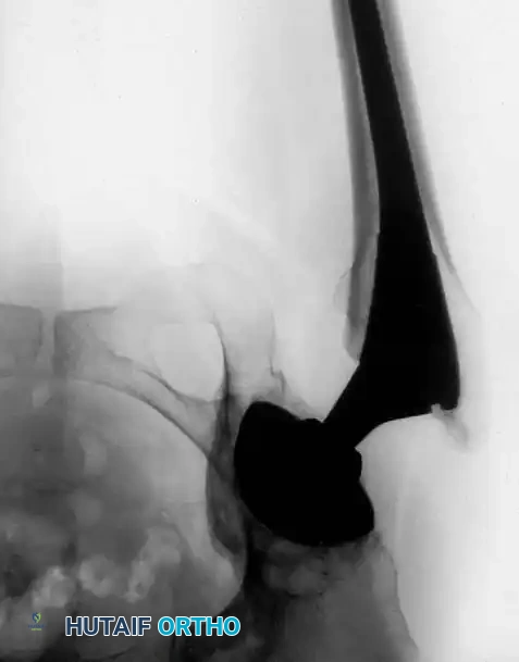 Fig. 7-75 Reconstruction for protrusio acetabuli deformity. A, Diagrammatic representation of medial wall grafting and lateralized cup placement.