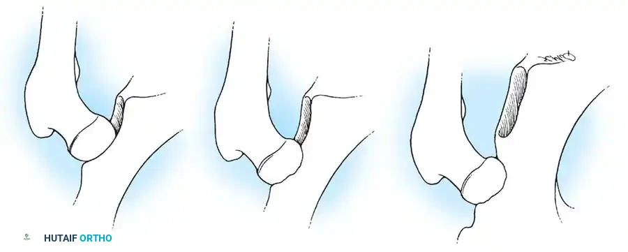 Final seating of the cementless acetabular shell with supplemental screw fixation.