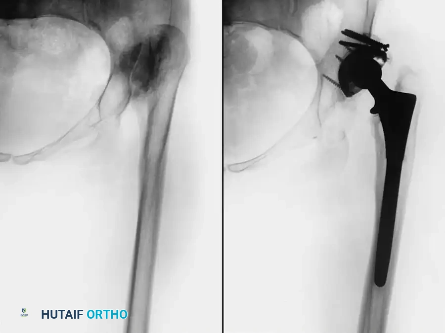Use of a multi-hole cup for enhanced screw fixation in poor bone stock.