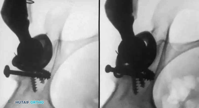 Trialing of the acetabular component to ensure adequate superior coverage.