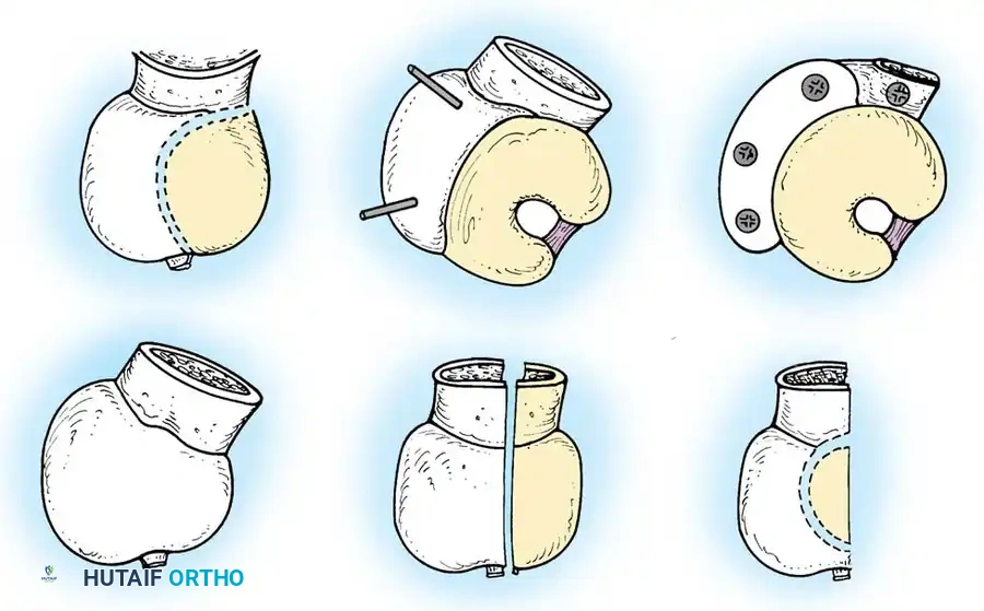 Intraoperative fluoroscopy confirming initial reamer positioning.