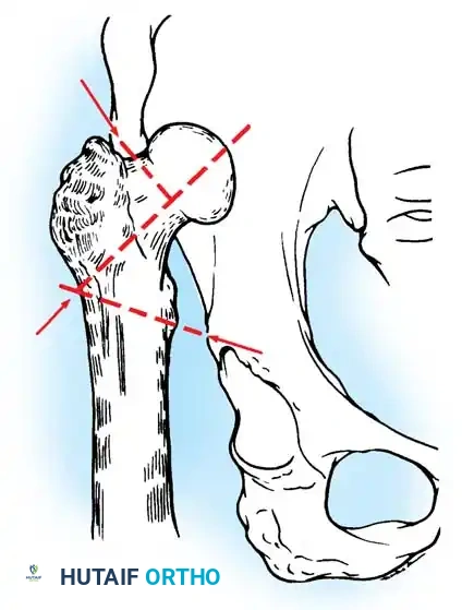 Postoperative AP pelvis showing restored offset and anatomic hip center.