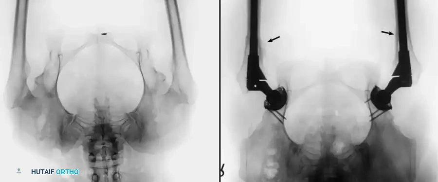 Careful reaming of the soft, osteopenic acetabulum to avoid medial wall blowout.