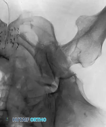 Intraoperative imaging showing retained fibular graft from a previous joint-preserving procedure.