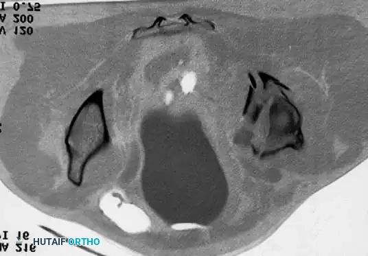 Final seating of a cementless femoral stem in optimal neutral alignment.