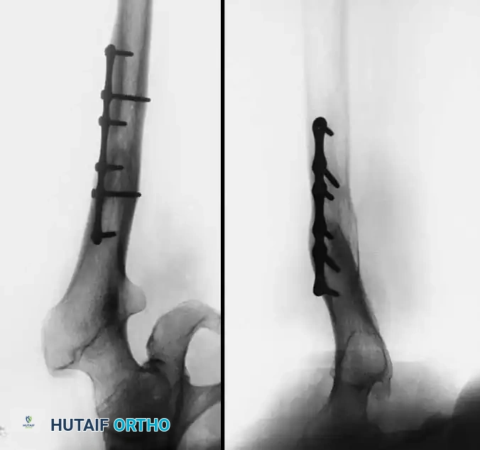 Fluoroscopic confirmation of proper broach alignment after graft removal.