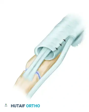 Superficial branch radial nerve