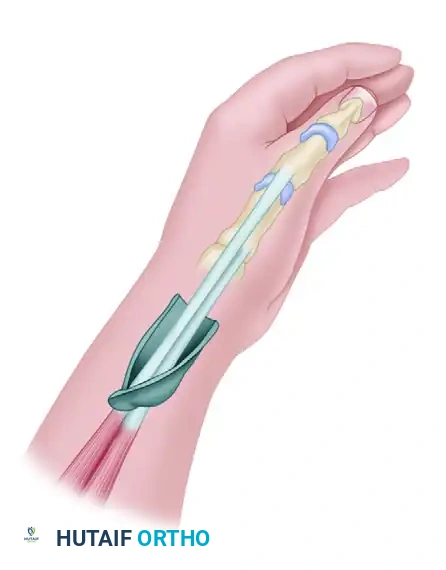 SURGICAL RELEASE OF TRIGGER FINGER Surgical Diagram