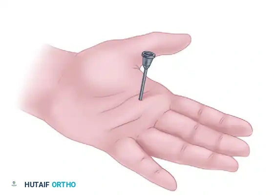 SURGICAL RELEASE OF TRIGGER FINGER Surgical Diagram