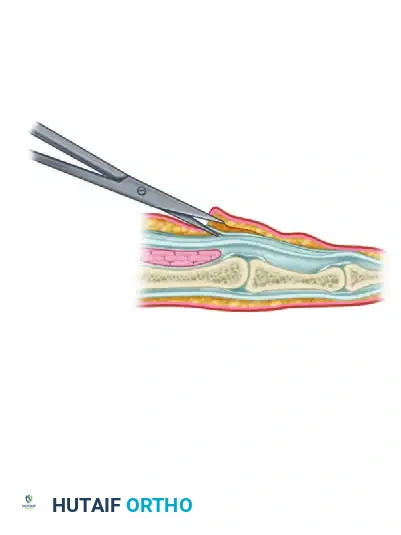 SURGICAL RELEASE OF TRIGGER FINGER Surgical Diagram