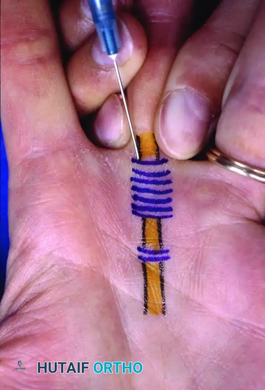 FIGURE 76-22 A, Percutaneous release of long finger A1 pulley...