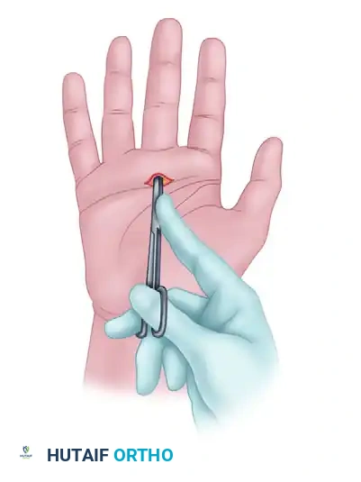 SURGICAL RELEASE OF TRIGGER FINGER Surgical Diagram