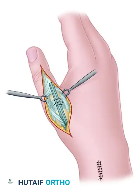 SWAN-NECK DEFORMITY Surgical Diagram