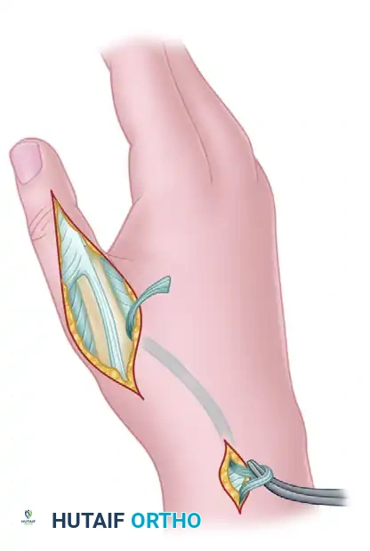 SWAN-NECK DEFORMITY Surgical Diagram