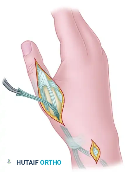 SWAN-NECK DEFORMITY Surgical Diagram