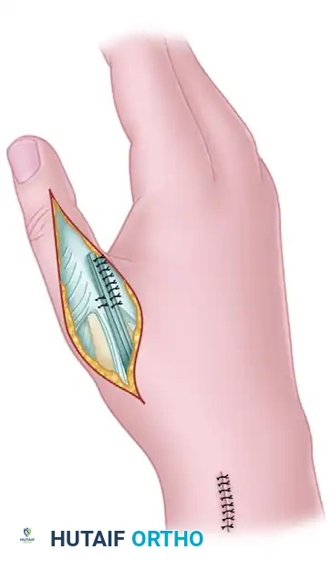 SWAN-NECK DEFORMITY Surgical Diagram
