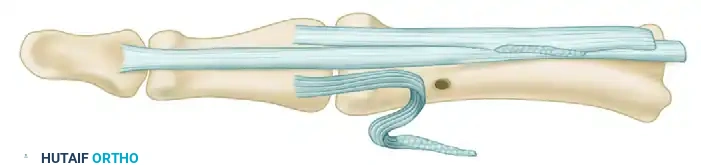 SWAN-NECK DEFORMITY Surgical Diagram