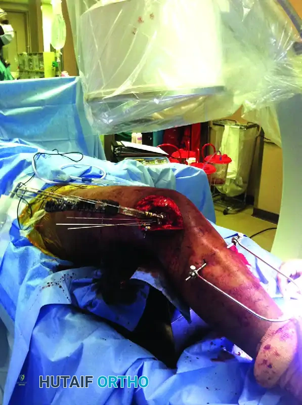 The Swashbuckler Approach to the Distal Femur: A Comprehensive Surgical Guide