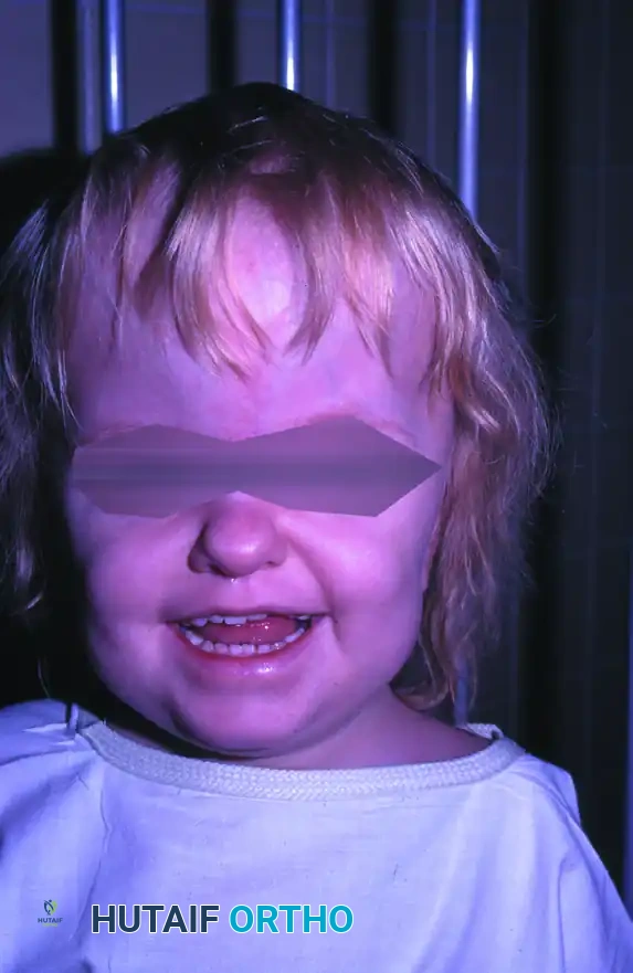 Comprehensive Surgical Management of Syndactyly and Apert Syndrome Hand Deformities