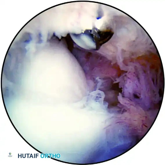 SYNOVECTOMY Surgical Diagram