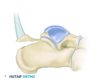 Type I Sleeve Fracture Diagram A