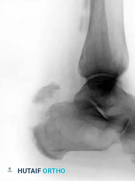 Type II Beak Fracture Diagram C