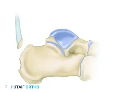 Type II Beak Fracture Diagram D