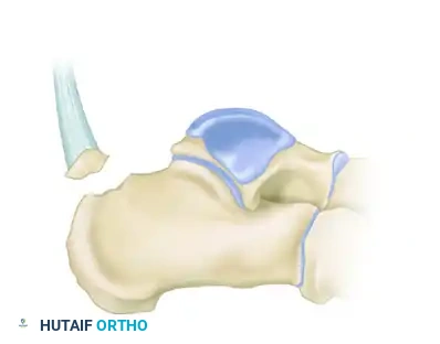 Type III Infrabursal Fracture Diagram E