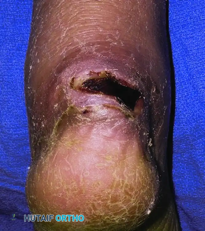 Skin Necrosis 1 Month Post-Injury