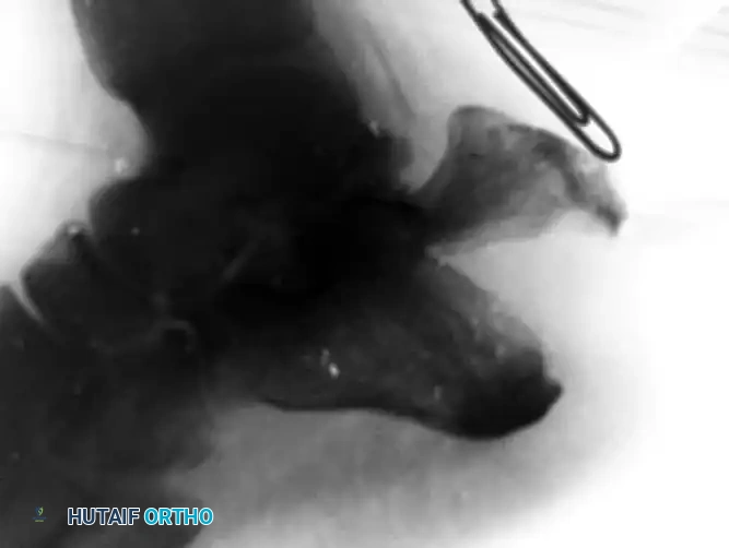 Displaced Beak Fracture X-Ray