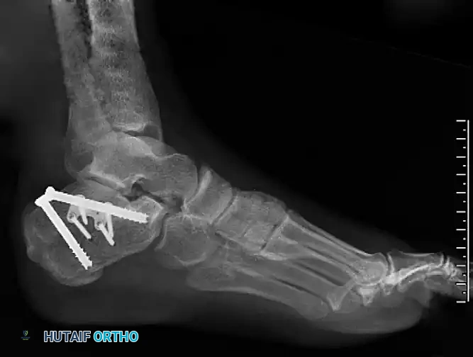 Tension Band Fixation