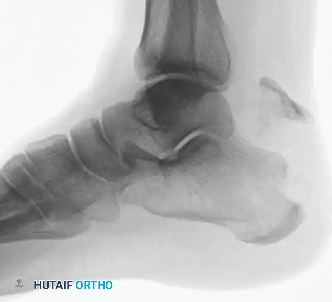 Plate and Screw Fixation A