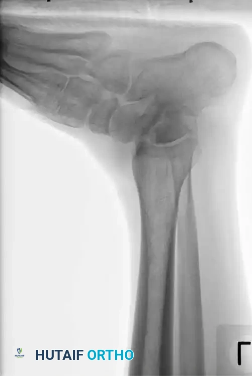 Talar head/neck X-ray example