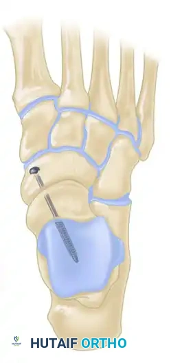 TALONAVICULAR JOINT ARTHRODESIS Surgical Diagram