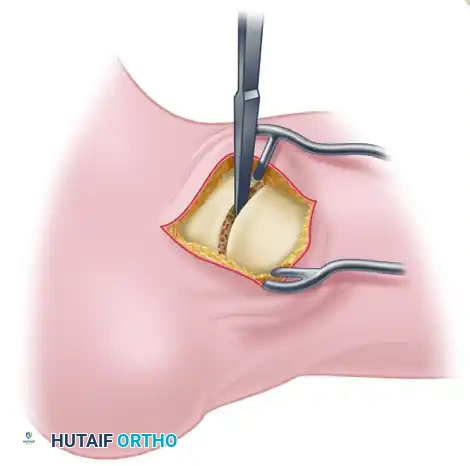 TALONAVICULAR JOINT ARTHRODESIS Surgical Diagram