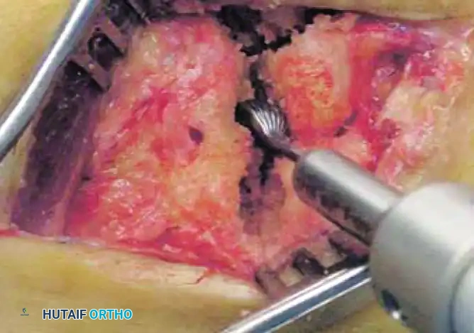 TARSOMETATARSAL INTERPOSITIONAL ARTHROPLASTY Surgical Diagram