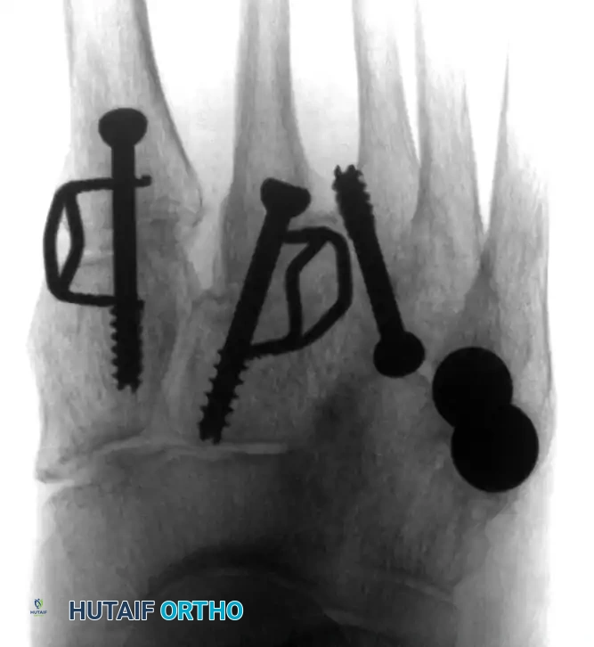 TARSOMETATARSAL INTERPOSITIONAL ARTHROPLASTY Surgical Diagram