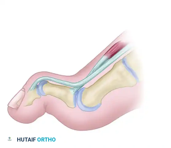 TENDON SUSPENSION OF THE FIRST METATARSAL AND INTERPHALANGEAL JOINT ARTHRODESIS Surgical Diagram