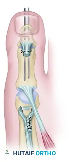TENDON SUSPENSION OF THE FIRST METATARSAL AND INTERPHALANGEAL JOINT ARTHRODESIS Surgical Diagram