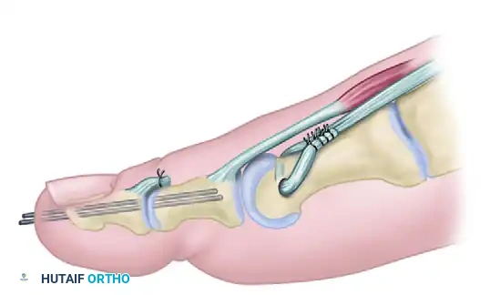 TENDON SUSPENSION OF THE FIRST METATARSAL AND INTERPHALANGEAL JOINT ARTHRODESIS Surgical Diagram