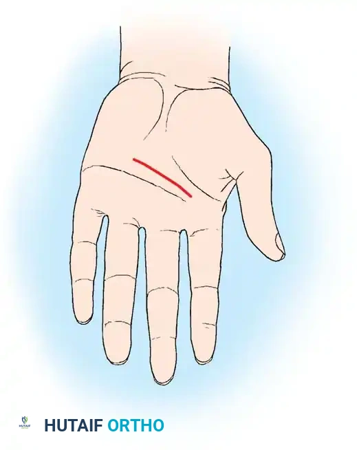 Transverse palmar incision